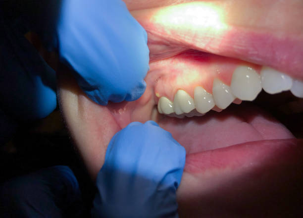 Best Urgent Care for Lost Fillings or Crowns in Wesley Chapel, NC